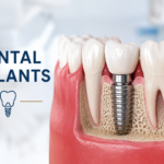 dental implants